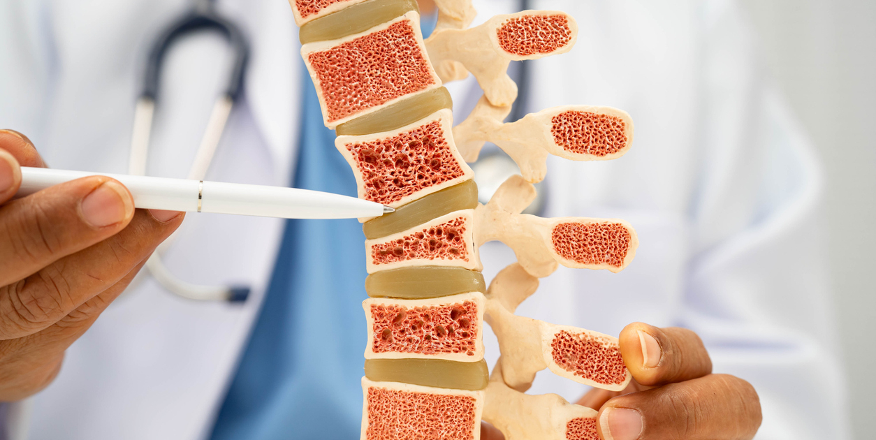 Doctor holding osteoporosis in back bone model for treatment medical in orthopedic department.